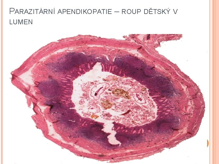 PARAZITÁRNÍ APENDIKOPATIE – ROUP DĚTSKÝ V LUMEN 