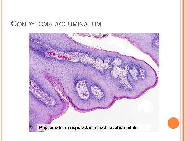 CONDYLOMA ACCUMINATUM Papilomatózní uspořádání dlaždicového epitelu 