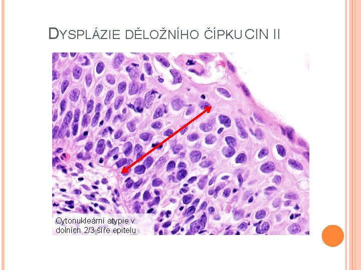 DYSPLÁZIE DĚLOŽNÍHO ČÍPKU CIN II Cytonukleární atypie v dolních 2/3 šíře epitelu 