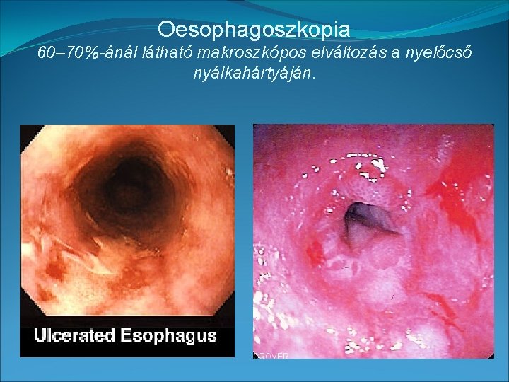 Oesophagoszkopia 60– 70%-ánál látható makroszkópos elváltozás a nyelőcső nyálkahártyáján. 