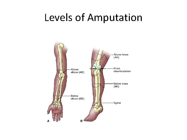 Levels of Amputation 