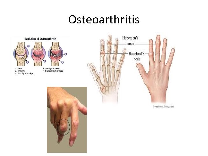 Osteoarthritis 