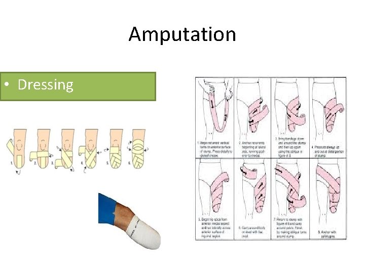 Amputation • Dressing 