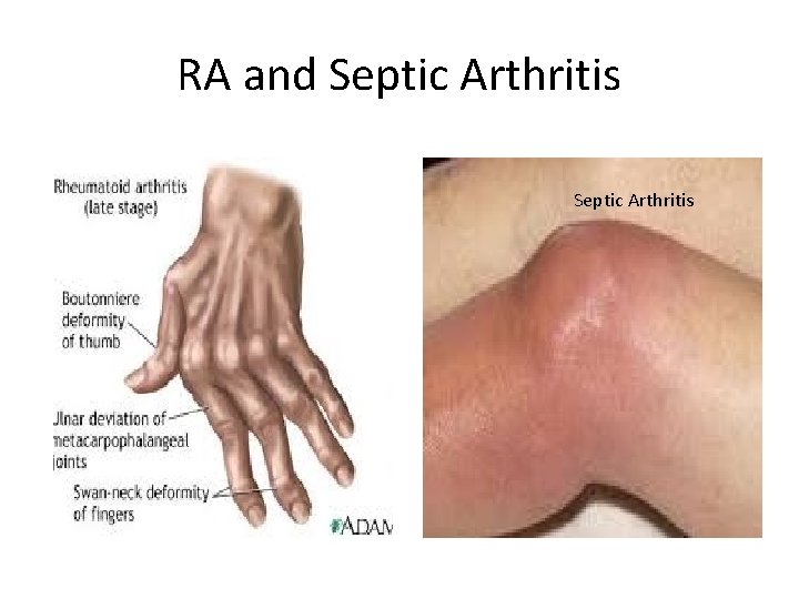 RA and Septic Arthritis 
