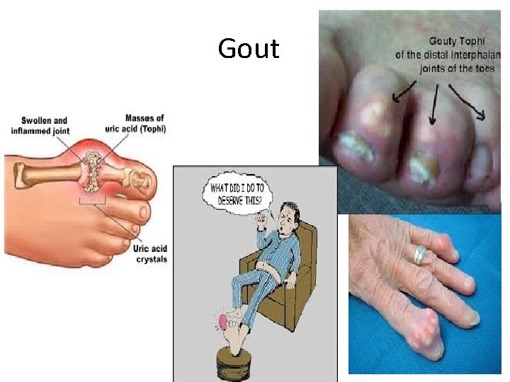 Gout 
