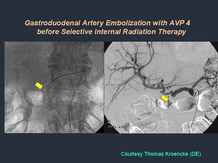 Gastroduodenal Artery Embolization with AVP 4 before Selective Internal Radiation Therapy Courtesy Thomas Kroencke Gastroduodenal Artery Embolization with AVP 4 before Selective Internal Radiation Therapy Courtesy Thomas Kroencke