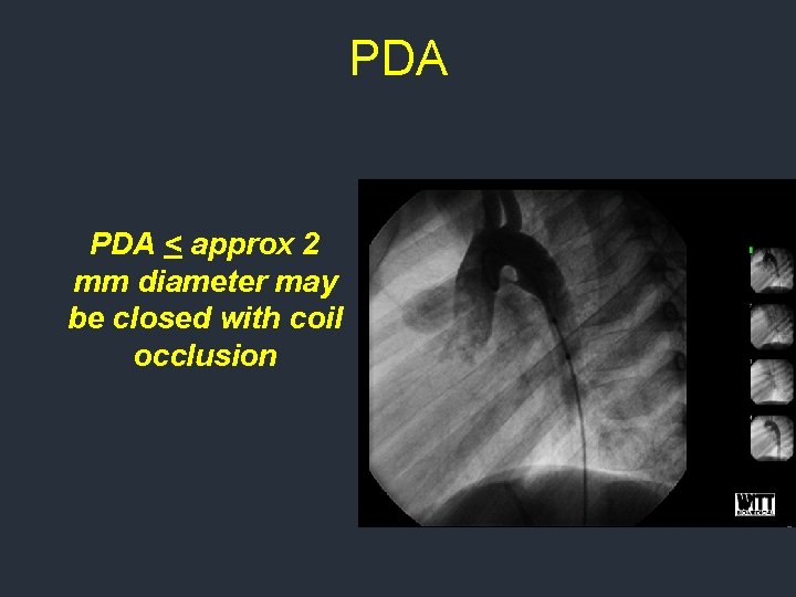 PDA < approx 2 mm diameter may be closed with coil occlusion PDA < approx 2 mm diameter may be closed with coil occlusion