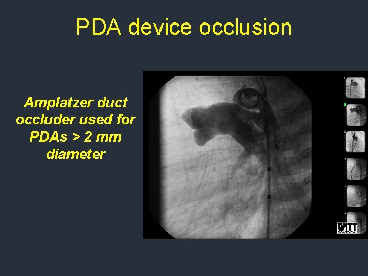 PDA device occlusion Amplatzer duct occluder used for PDAs > 2 mm diameter PDA device occlusion Amplatzer duct occluder used for PDAs > 2 mm diameter