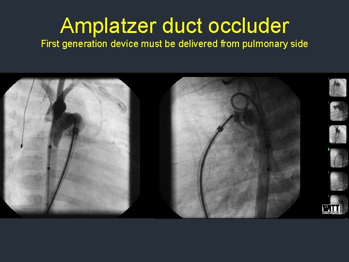 Amplatzer duct occluder First generation device must be delivered from pulmonary side Amplatzer duct occluder First generation device must be delivered from pulmonary side