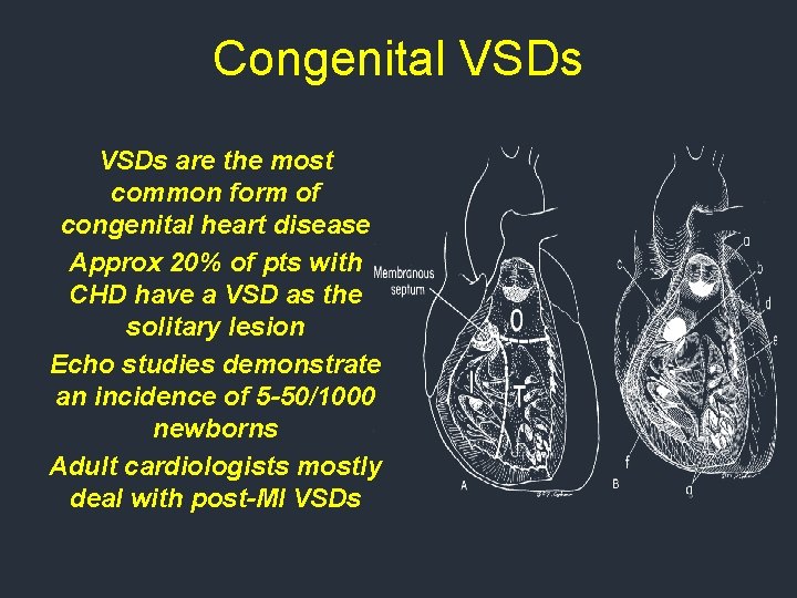 Congenital VSDs are the most common form of congenital heart disease Approx 20% of Congenital VSDs are the most common form of congenital heart disease Approx 20% of