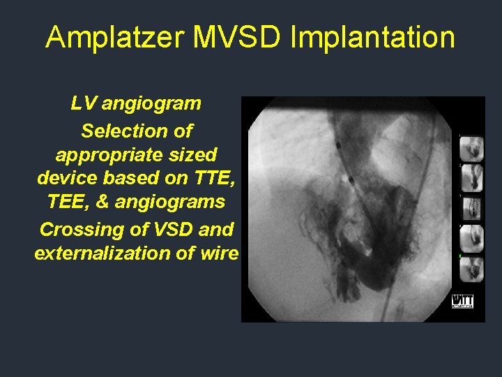 Amplatzer MVSD Implantation LV angiogram Selection of appropriate sized device based on TTE, TEE, Amplatzer MVSD Implantation LV angiogram Selection of appropriate sized device based on TTE, TEE,