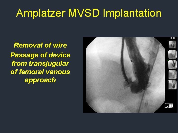 Amplatzer MVSD Implantation Removal of wire Passage of device from transjugular of femoral venous Amplatzer MVSD Implantation Removal of wire Passage of device from transjugular of femoral venous