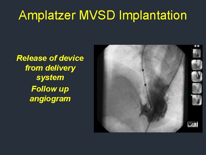 Amplatzer MVSD Implantation Release of device from delivery system Follow up angiogram Amplatzer MVSD Implantation Release of device from delivery system Follow up angiogram