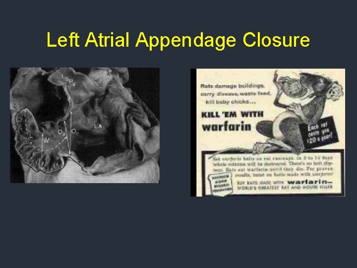 Left Atrial Appendage Closure Left Atrial Appendage Closure