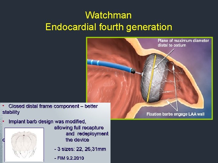 Watchman Endocardial fourth generation Watchman Endocardial fourth generation