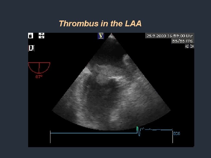 Thrombus in the LAA Thrombus in the LAA