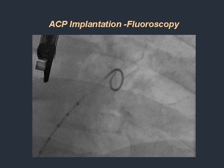 ACP Implantation -Fluoroscopy ACP Implantation -Fluoroscopy