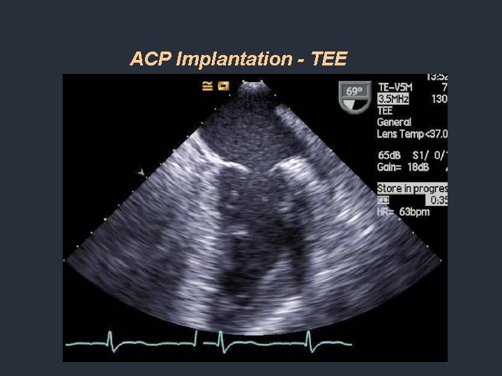ACP Implantation - TEE ACP Implantation - TEE