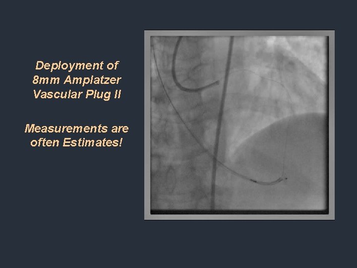 Deployment of 8 mm Amplatzer Vascular Plug II Measurements are often Estimates! Deployment of 8 mm Amplatzer Vascular Plug II Measurements are often Estimates!