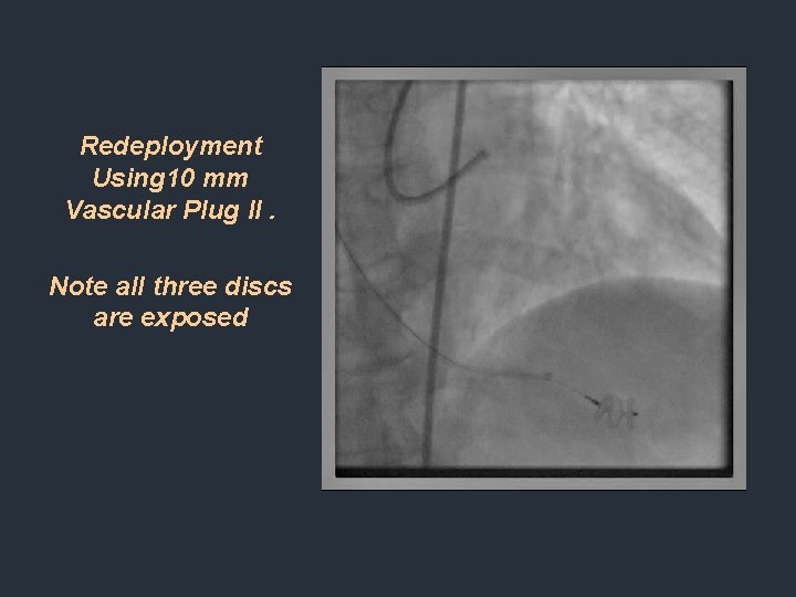 Redeployment Using 10 mm Vascular Plug II. Note all three discs are exposed Redeployment Using 10 mm Vascular Plug II. Note all three discs are exposed