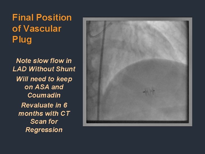 Final Position of Vascular Plug Note slow flow in LAD Without Shunt Will need Final Position of Vascular Plug Note slow flow in LAD Without Shunt Will need