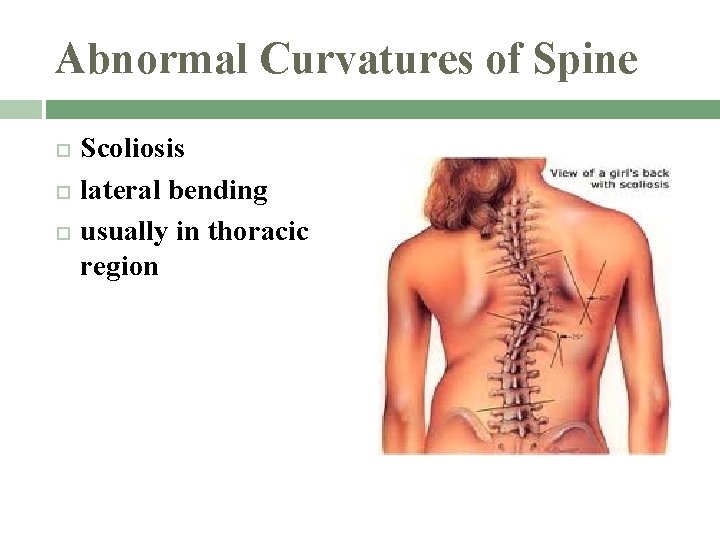 Abnormal Curvatures of Spine Scoliosis lateral bending usually in thoracic region 