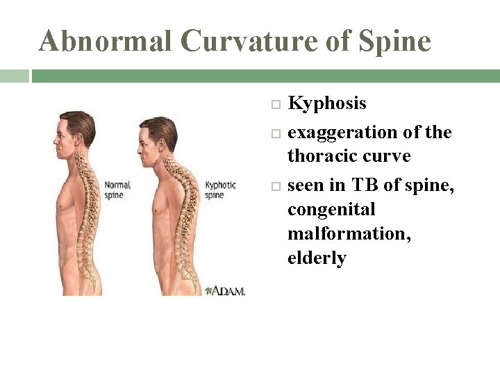 Abnormal Curvature of Spine Kyphosis exaggeration of the thoracic curve seen in TB of