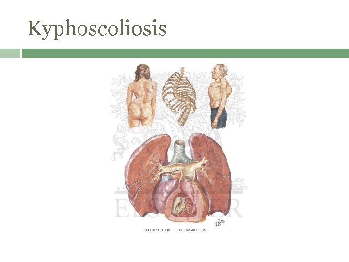 Kyphoscoliosis 