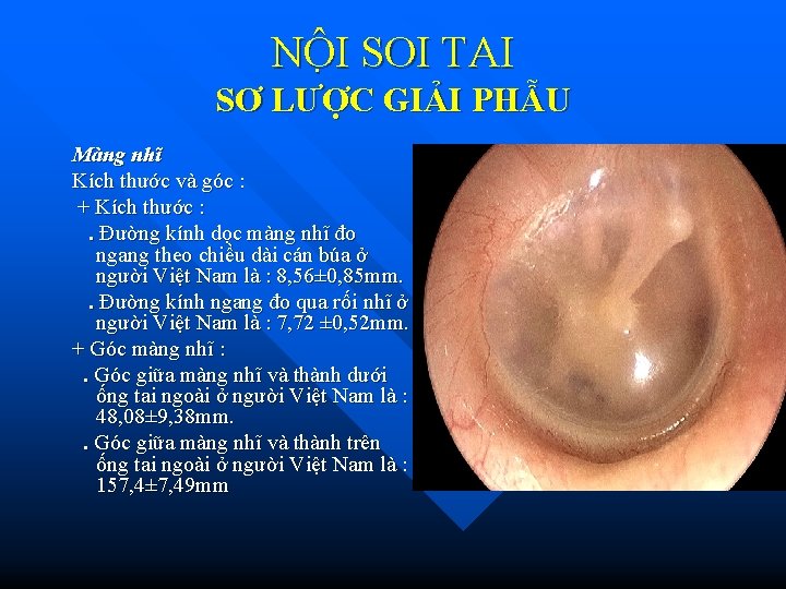 NÔ I SOI TAI SƠ LƯỢC GIẢI PHẪU Màng nhĩ Kích thước và góc