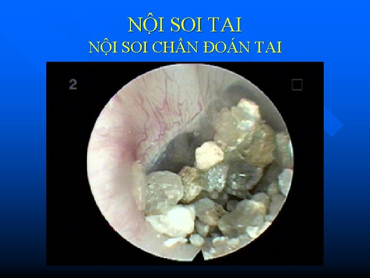 NÔ I SOI TAI NỘI SOI CHẨN ĐOÁN TAI NÔ I SOI TAI NỘI SOI CHẨN ĐOÁN TAI