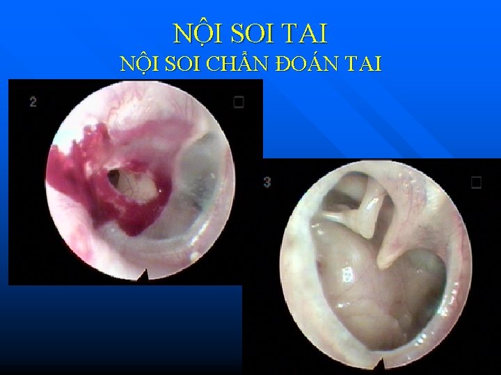 NÔ I SOI TAI NỘI SOI CHẨN ĐOÁN TAI 