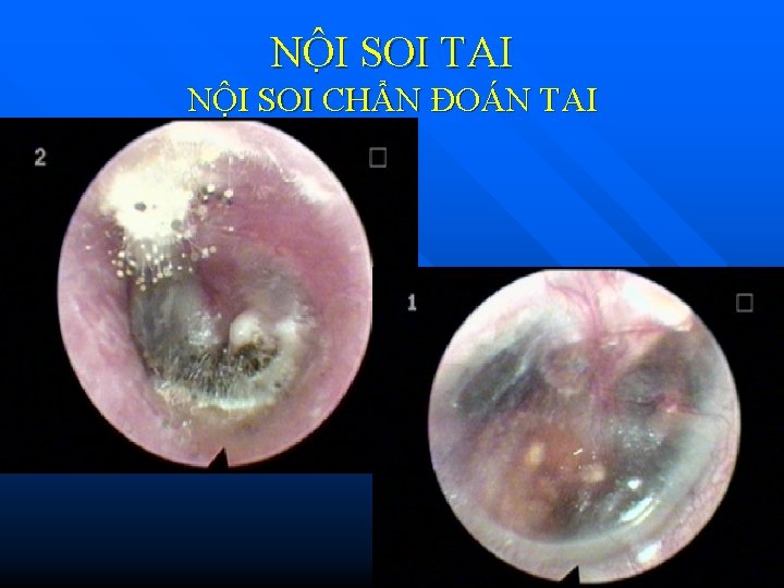 NÔ I SOI TAI NỘI SOI CHẨN ĐOÁN TAI NÔ I SOI TAI NỘI SOI CHẨN ĐOÁN TAI