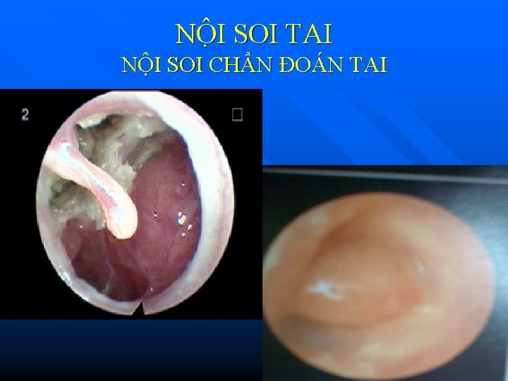 NÔ I SOI TAI NỘI SOI CHẨN ĐOÁN TAI NÔ I SOI TAI NỘI SOI CHẨN ĐOÁN TAI
