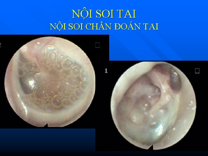 NÔ I SOI TAI NỘI SOI CHẨN ĐOÁN TAI NÔ I SOI TAI NỘI SOI CHẨN ĐOÁN TAI
