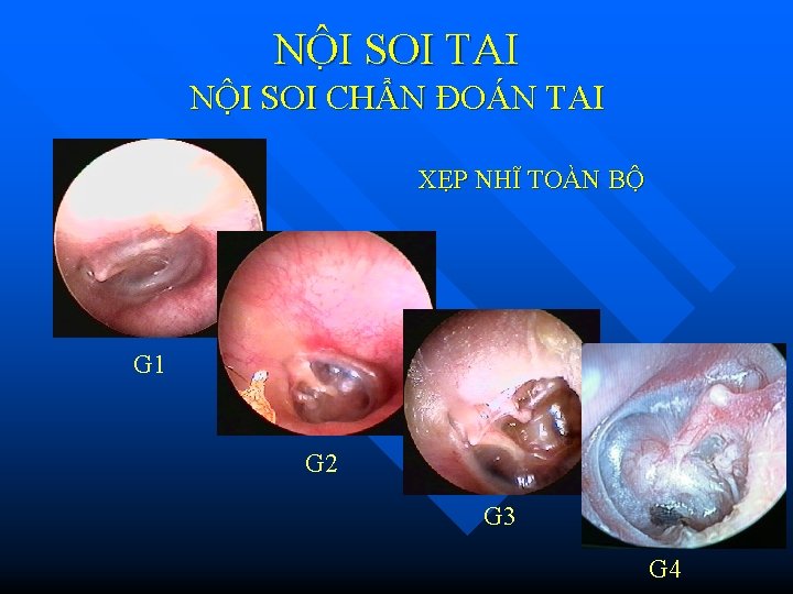 NÔ I SOI TAI NỘI SOI CHẨN ĐOÁN TAI XẸP NHĨ TOÀN BỘ G