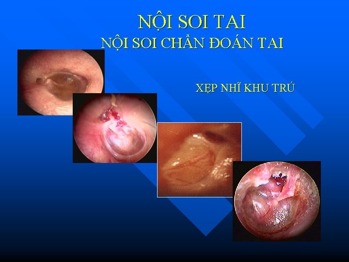 NÔ I SOI TAI NỘI SOI CHẨN ĐOÁN TAI XẸP NHĨ KHU TRÚ 