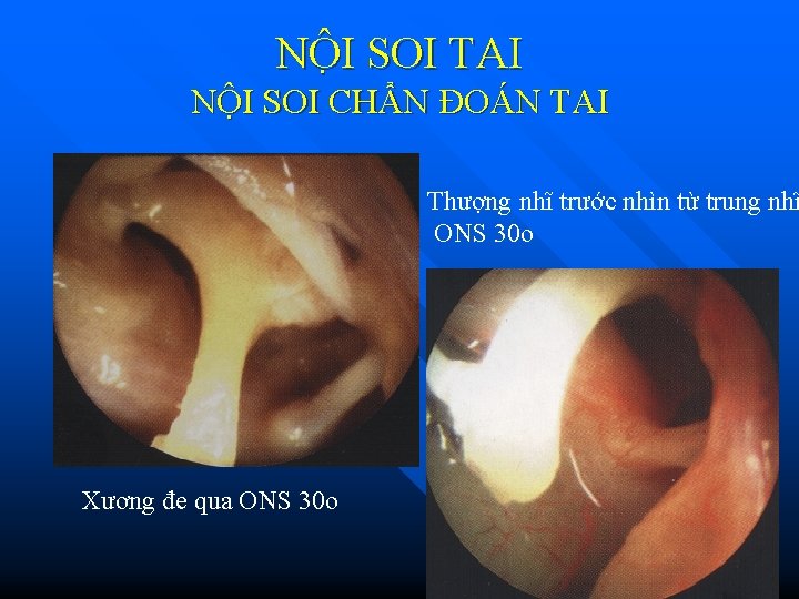 NÔ I SOI TAI NỘI SOI CHẨN ĐOÁN TAI Thượng nhĩ trước nhìn từ