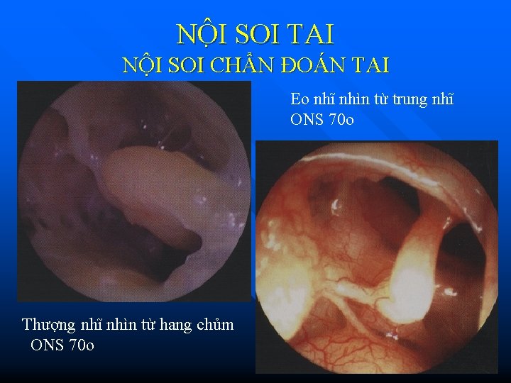 NÔ I SOI TAI NỘI SOI CHẨN ĐOÁN TAI Eo nhĩ nhìn từ trung NÔ I SOI TAI NỘI SOI CHẨN ĐOÁN TAI Eo nhĩ nhìn từ trung
