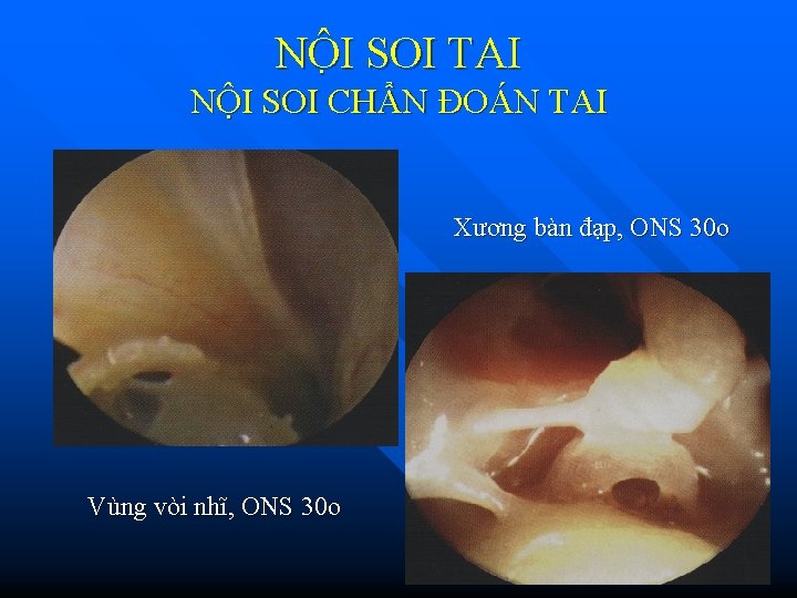 NÔ I SOI TAI NỘI SOI CHẨN ĐOÁN TAI n Xương bàn đạp, ONS