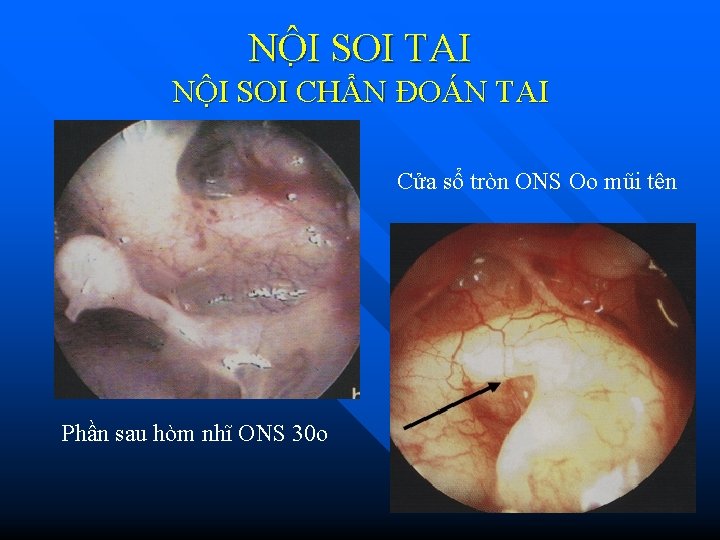 NÔ I SOI TAI NỘI SOI CHẨN ĐOÁN TAI Cửa sổ tròn ONS Oo