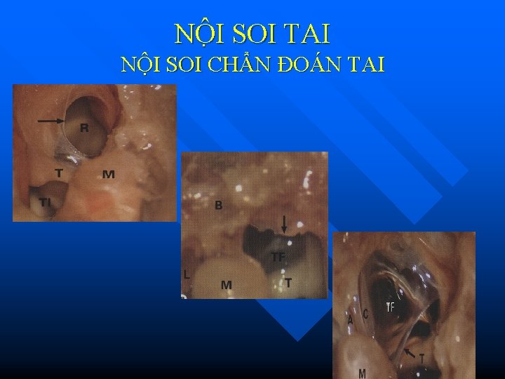NÔ I SOI TAI NỘI SOI CHẨN ĐOÁN TAI NÔ I SOI TAI NỘI SOI CHẨN ĐOÁN TAI