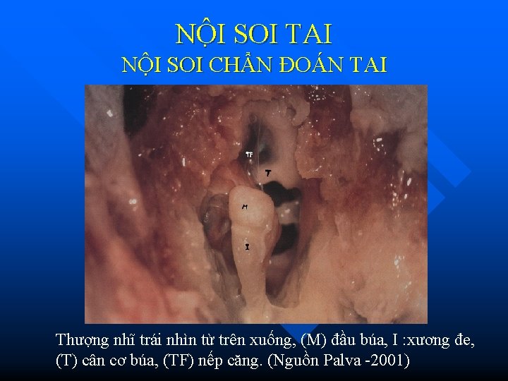 NÔ I SOI TAI NỘI SOI CHẨN ĐOÁN TAI Thượng nhĩ trái nhìn từ