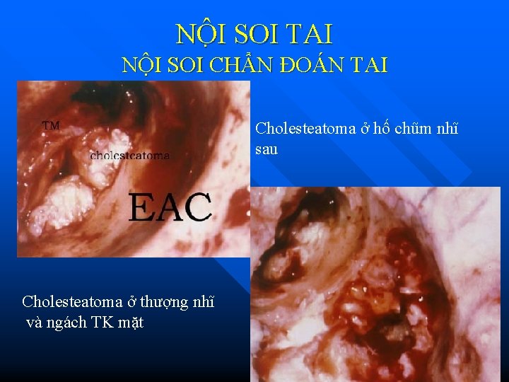 NÔ I SOI TAI NỘI SOI CHẨN ĐOÁN TAI Cholesteatoma ở hố chũm nhĩ