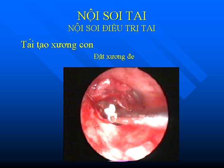 NÔ I SOI TAI NỘI SOI ĐIỀU TRỊ TAI Ta i ta o xương NÔ I SOI TAI NỘI SOI ĐIỀU TRỊ TAI Ta i ta o xương