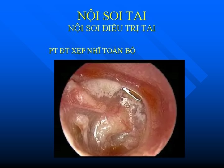 NÔ I SOI TAI NỘI SOI ĐIỀU TRỊ TAI PT ĐT XẸP NHĨ TOÀN