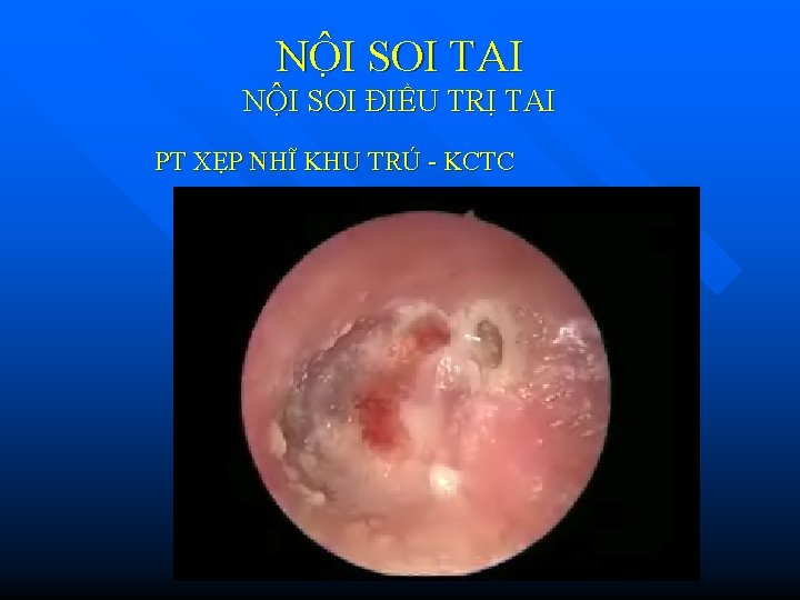 NÔ I SOI TAI NỘI SOI ĐIỀU TRỊ TAI PT XẸP NHĨ KHU TRÚ NÔ I SOI TAI NỘI SOI ĐIỀU TRỊ TAI PT XẸP NHĨ KHU TRÚ