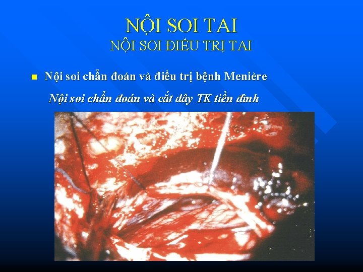 NÔ I SOI TAI NỘI SOI ĐIỀU TRỊ TAI n Nội soi chẩn đoán