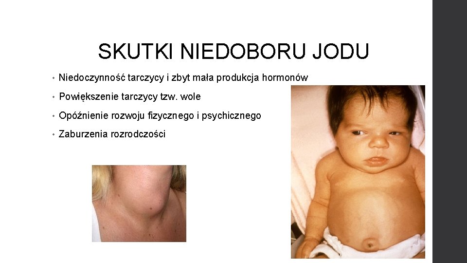 SKUTKI NIEDOBORU JODU • Niedoczynność tarczycy i zbyt mała produkcja hormonów • Powiększenie tarczycy