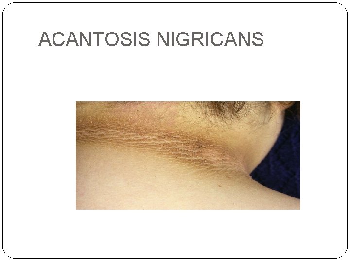 ACANTOSIS NIGRICANS ACANTOSIS NIGRICANS