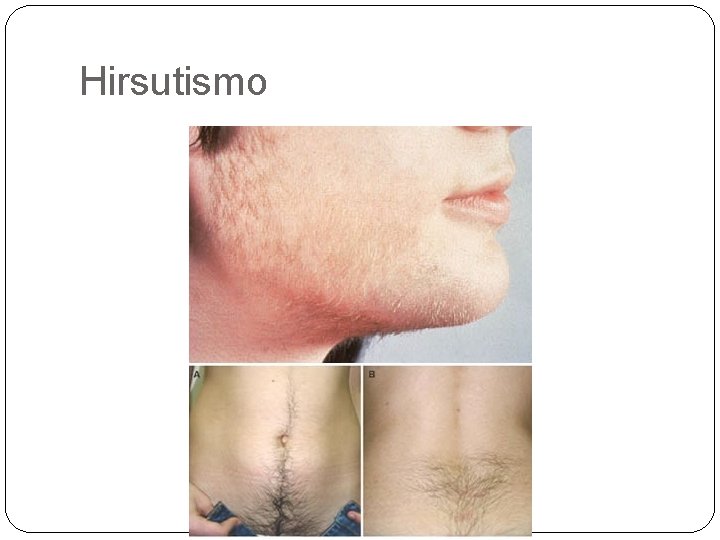 Hirsutismo Hirsutismo